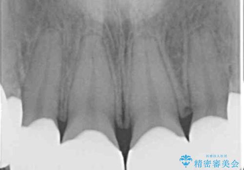 Kポップアイドルのような歯にしたい! 20代男性の治療後