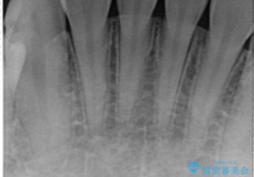 憧れの芸能人のような白い歯に 30代男性の治療前