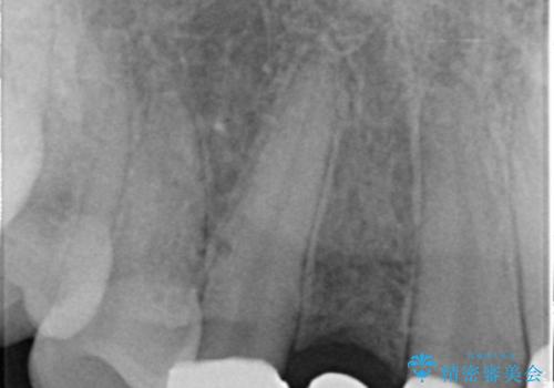 歯の位置異常 はやく治したい 矯正は嫌 20代女性の治療後