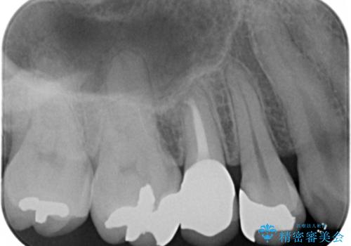 歯が欠けた セラミッククラウンで綺麗に 40代女性の治療後