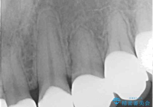 Kポップアイドルのような歯にしたい! 20代男性の治療後