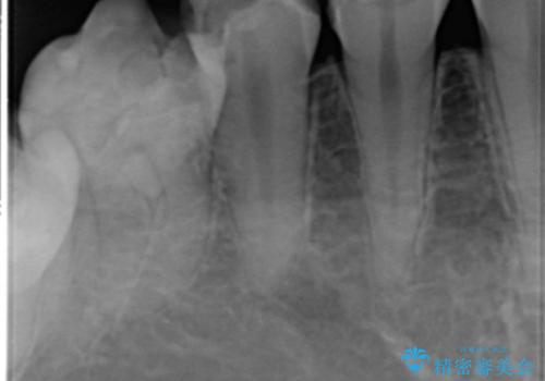 憧れの芸能人のような白い歯に 30代男性の治療前