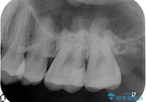 奥歯にフロスを通すと臭い 30代女性の治療後