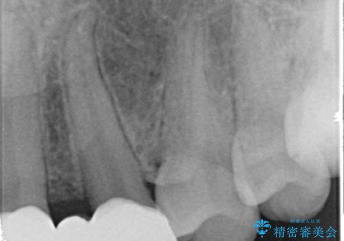 歯の位置異常 はやく治したい 矯正は嫌 20代女性の治療後