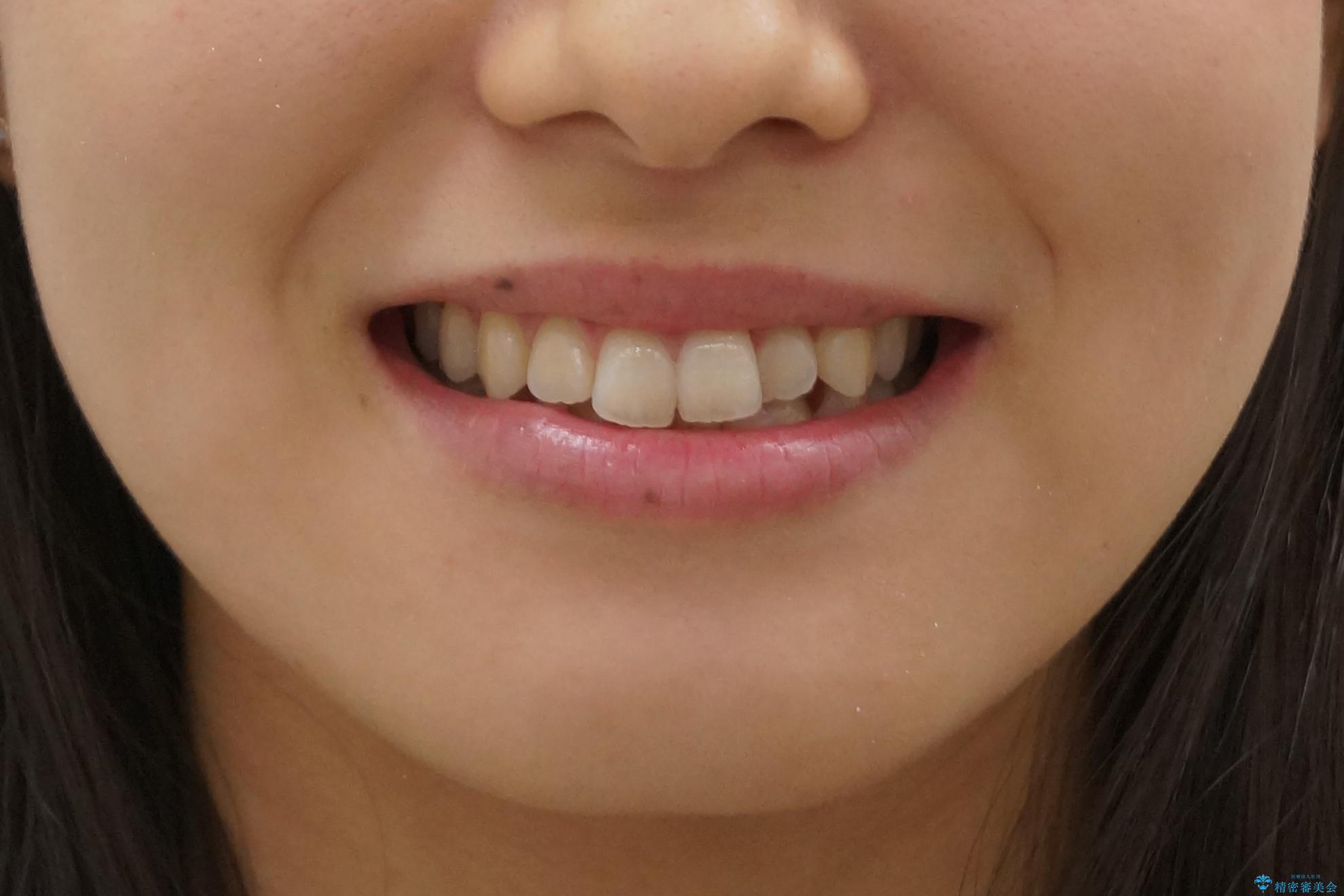 前歯のがたつき　インビザラインで　下の奥歯を後ろに下げるの治療前（顔貌）