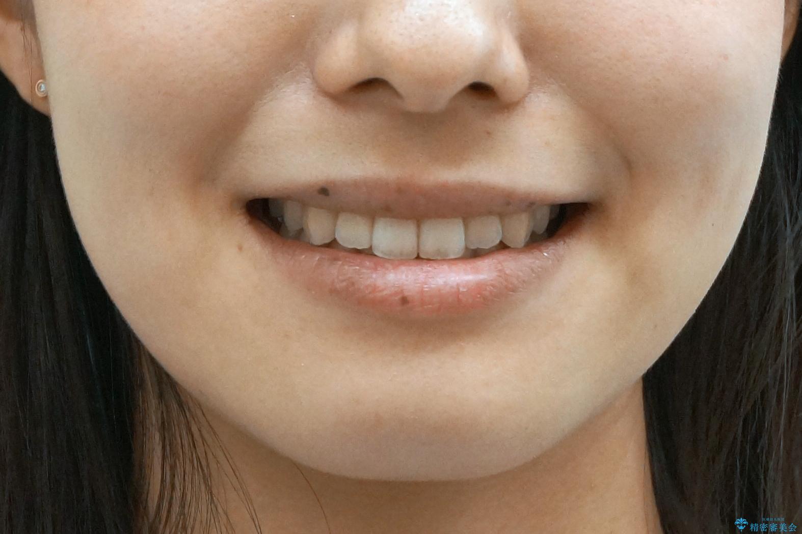 前歯のがたつき　インビザラインで　下の奥歯を後ろに下げるの治療後（顔貌）
