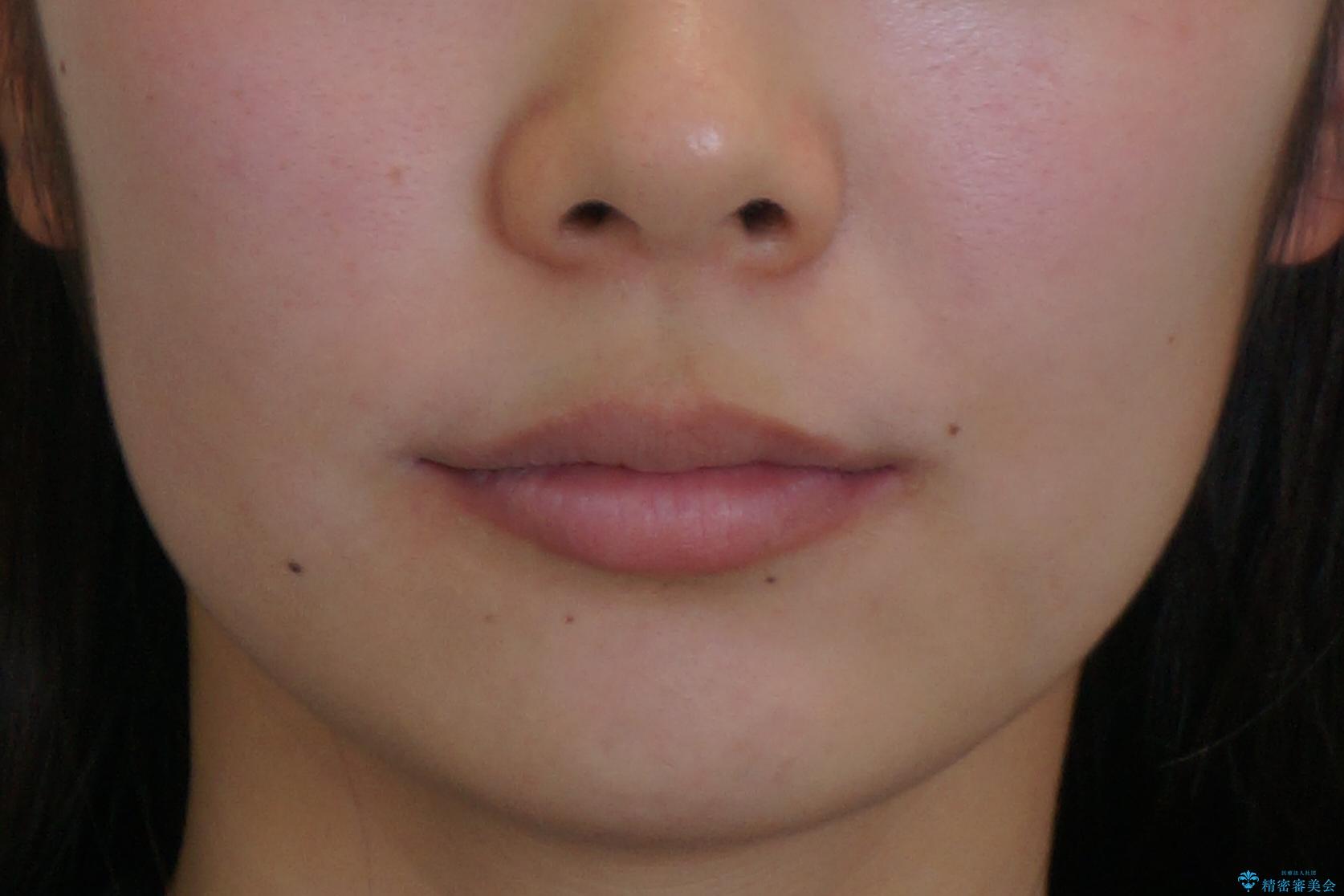 出っ歯を治したい 過蓋咬合の治療後(顔貌)