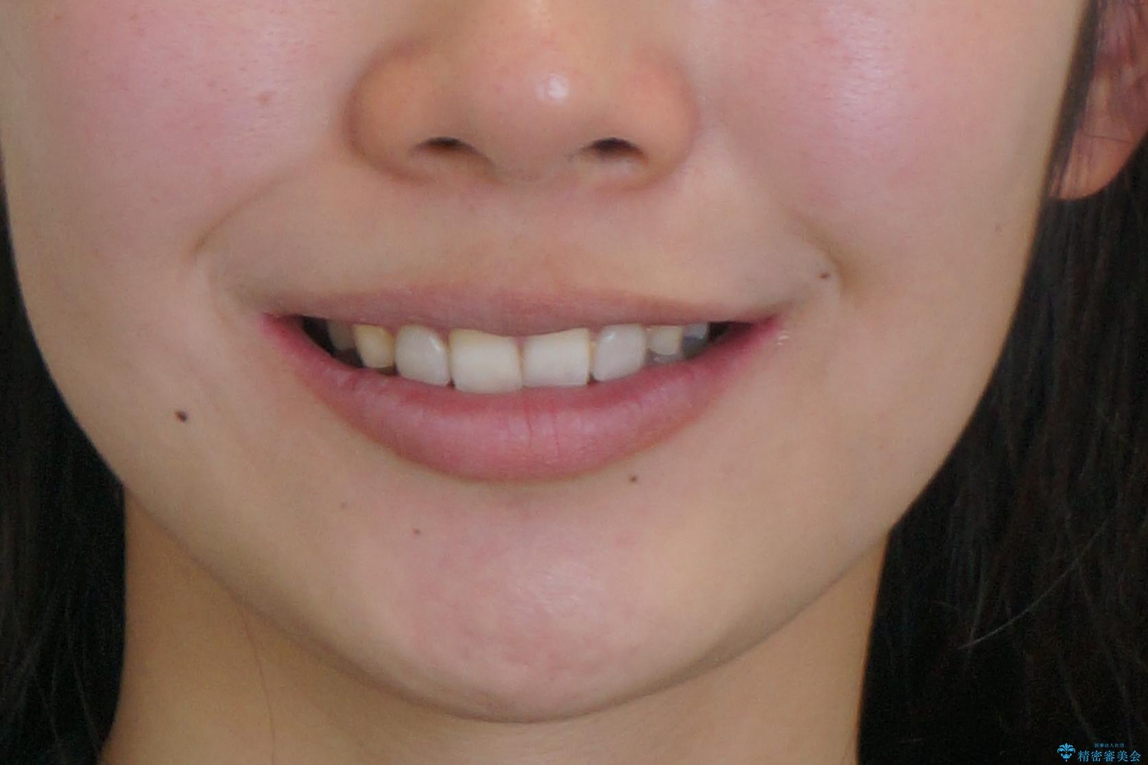 出っ歯を治したい　過蓋咬合の治療後（顔貌）