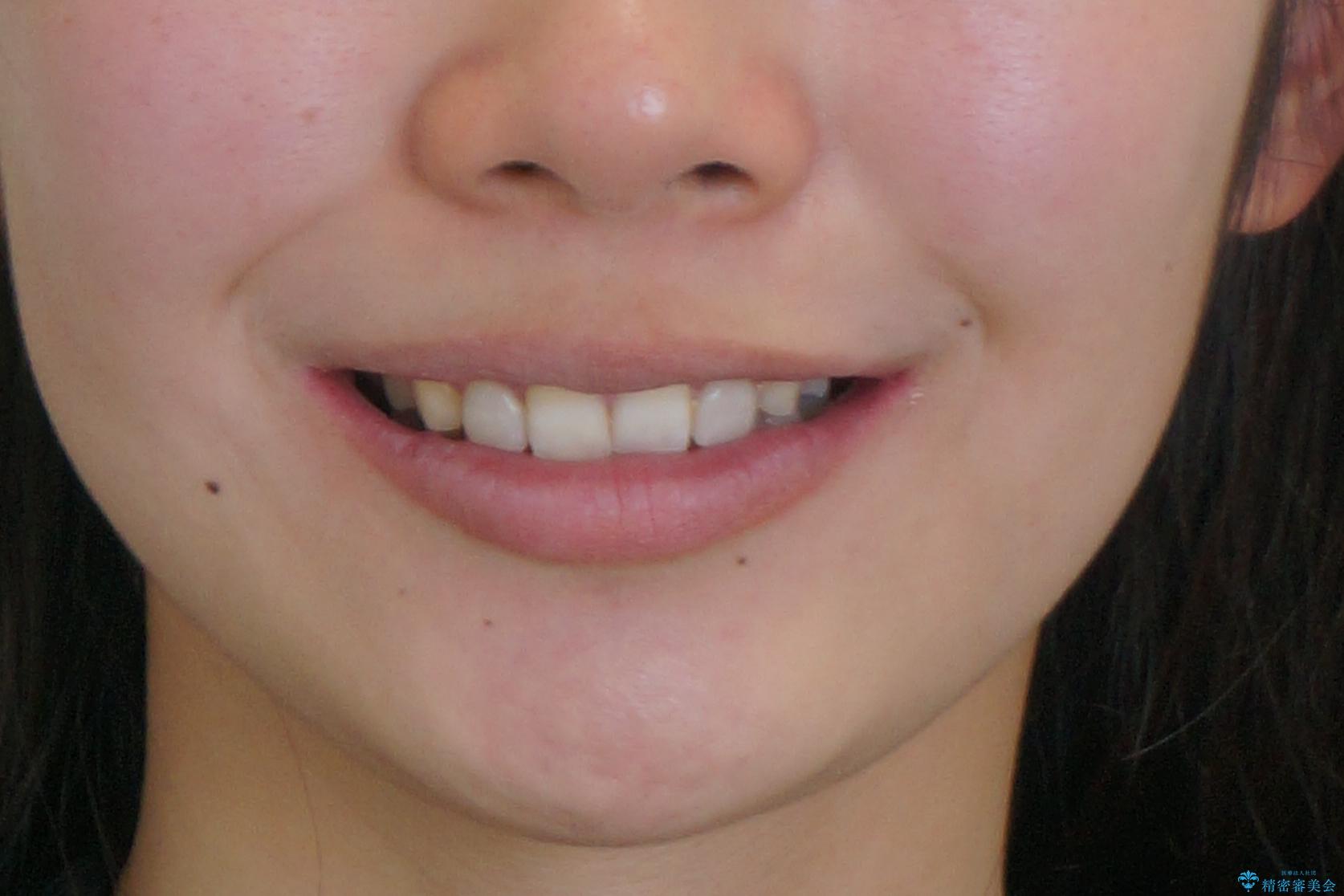 出っ歯を治したい 過蓋咬合の治療後(顔貌)