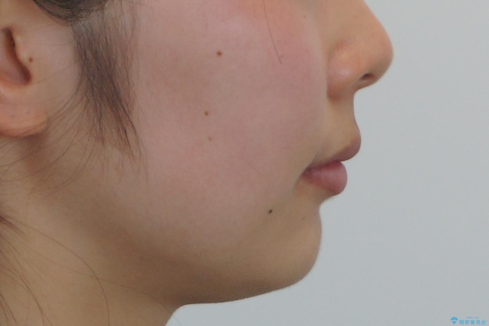 出っ歯を治したい 過蓋咬合の治療後(顔貌)