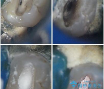 神経が死んで変色した歯 根管治療とオールセラミッククラウンの治療中