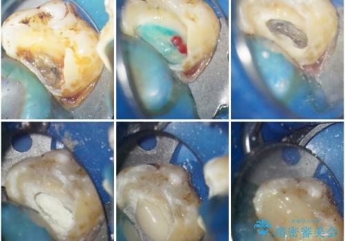 冷たいものがしみる 神経組織の一部を除去した虫歯治療の治療中