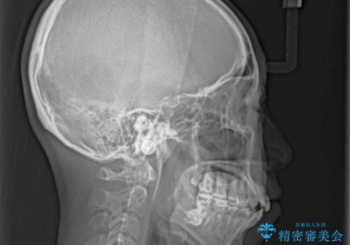 ダンサーとしての仕事を続けながら インビザラインによる抜歯矯正の治療前