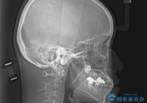 反対咬合で痛む前歯を改善 インビザラインによる矯正治療の治療前