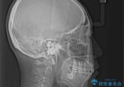 ダンサーとしての仕事を続けながら インビザラインによる抜歯矯正の治療後