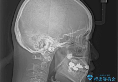 反対咬合で痛む前歯を改善 インビザラインによる矯正治療の治療後