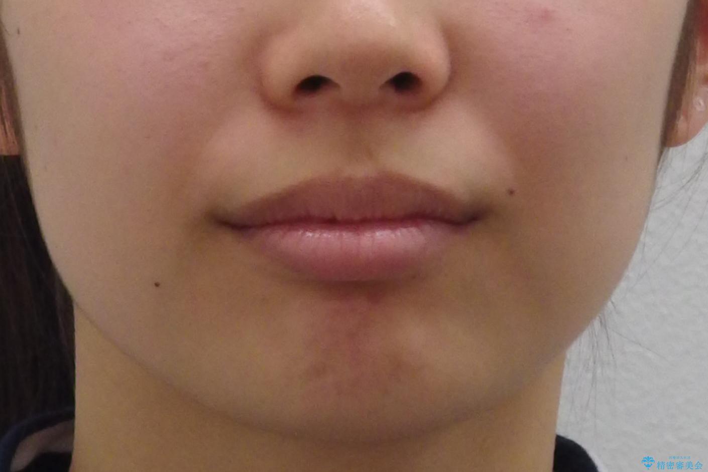 出っ歯を治したい 過蓋咬合の治療前(顔貌)