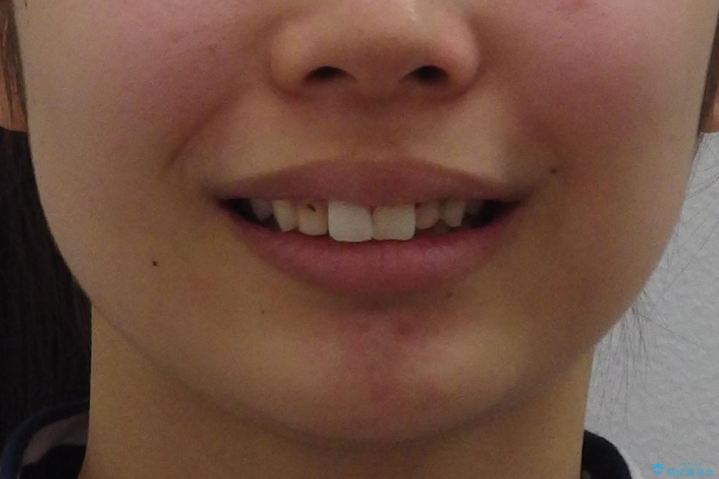 出っ歯を治したい 過蓋咬合の治療前(顔貌)