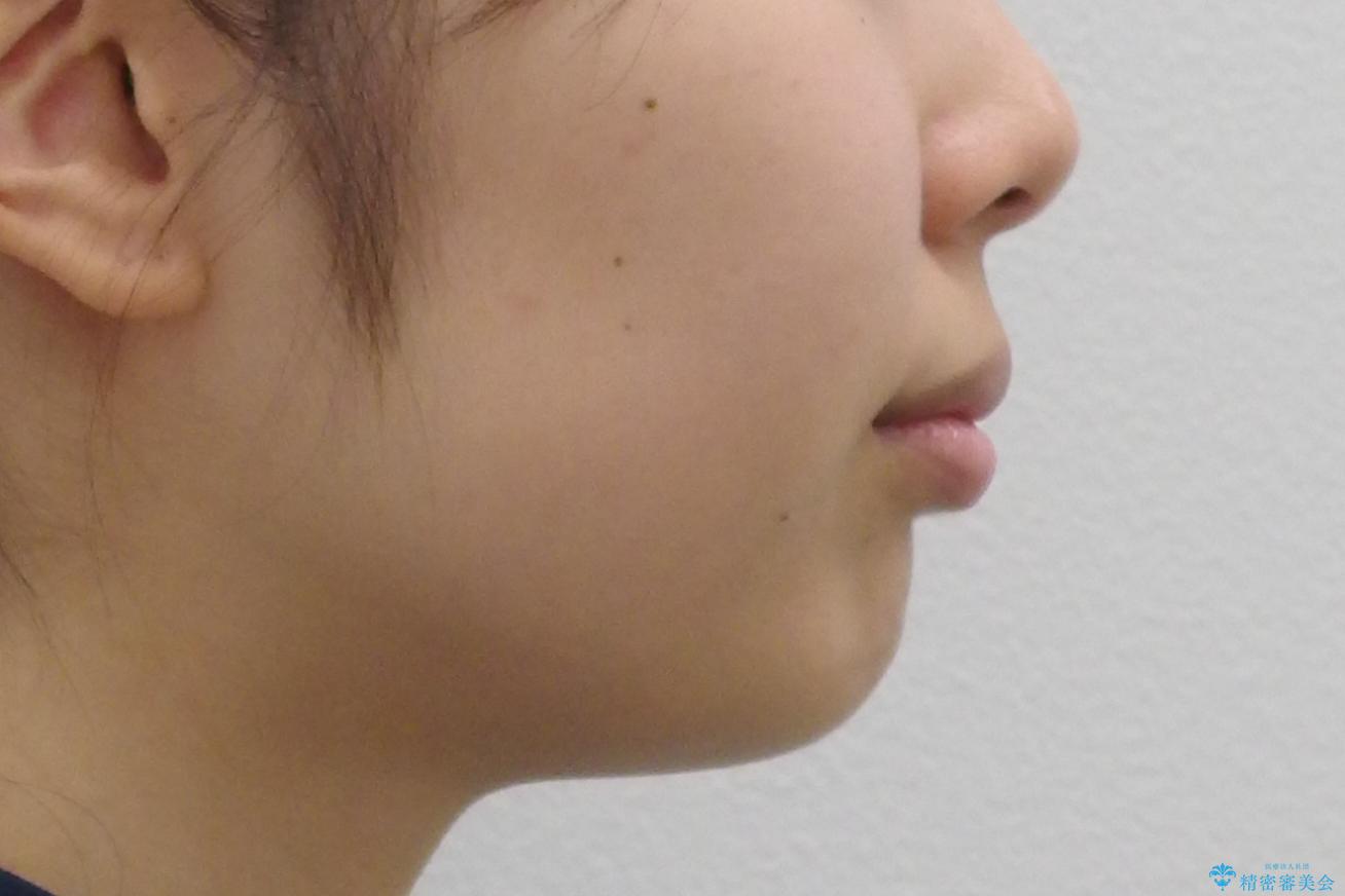 出っ歯を治したい 過蓋咬合の治療前(顔貌)