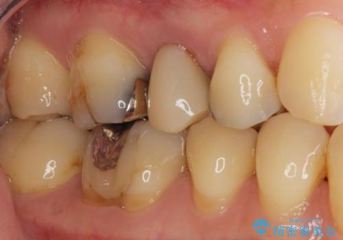歯が欠けた セラミッククラウンで綺麗に 40代女性の治療前