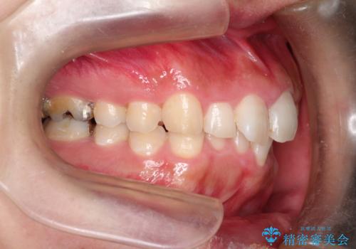 全体のガタガタをインビザラインできれいな歯並びへの治療前