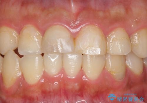 憧れの芸能人のような白い歯に 30代男性の治療前