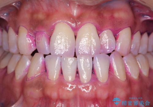 染め出しをして歯磨きチェックとPMTCの治療前