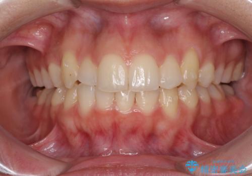 骨格的に左右にずれいている 前歯のデコボコをインビザラインで解消の治療中