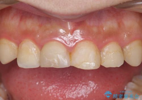 憧れの芸能人のような白い歯に 30代男性の治療前