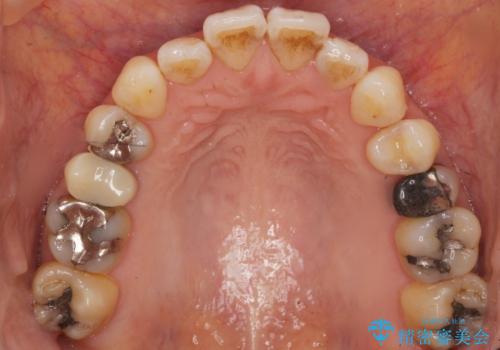 歯が欠けた セラミッククラウンで綺麗に 40代女性の治療前