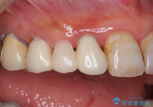 被せ物がかけた 綺麗で丈夫なセラミックのブリッジへ 60代女性の治療前