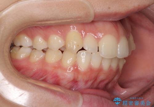 骨格的に左右にずれいている 前歯のデコボコをインビザラインで解消の治療中