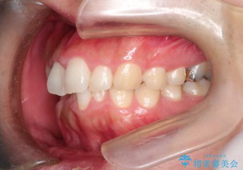 全体のガタガタをインビザラインできれいな歯並びへの治療前