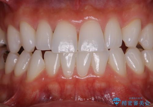 ホワイトニング前にPMTCの治療前