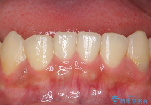 憧れの芸能人のような白い歯に 30代男性の治療前
