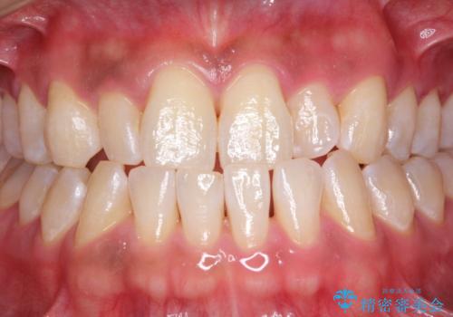 染め出しをして歯磨きチェックとPMTCの治療後