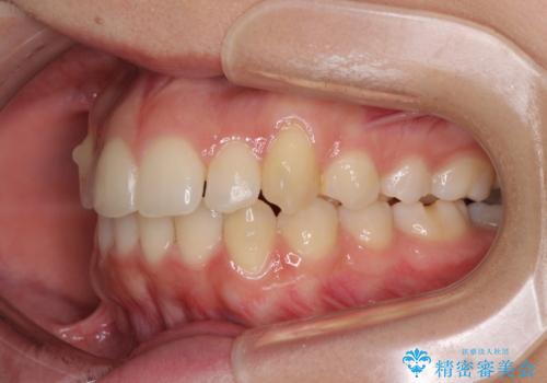 骨格的に左右にずれいている　前歯のデコボコをインビザラインで解消の治療中