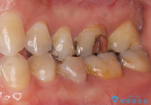 歯ぐきを押すと痛い 神経が死んでいる歯の治療 40代女性の症例 治療前