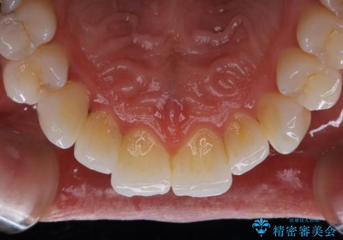 ホワイトニング前にPMTCの治療前