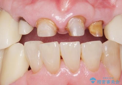 被せ物がとれたまま放置していた セラミックで綺麗に 50代男性の治療中