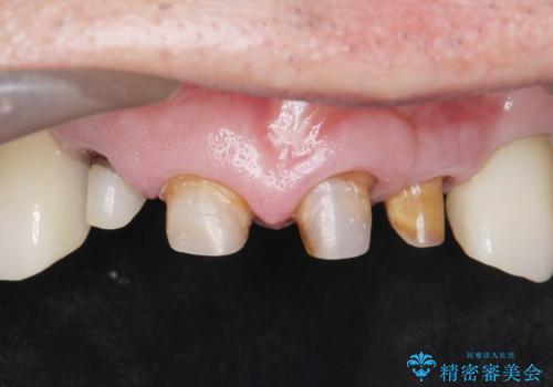 被せ物がとれたまま放置していた セラミックで綺麗に 50代男性の治療中