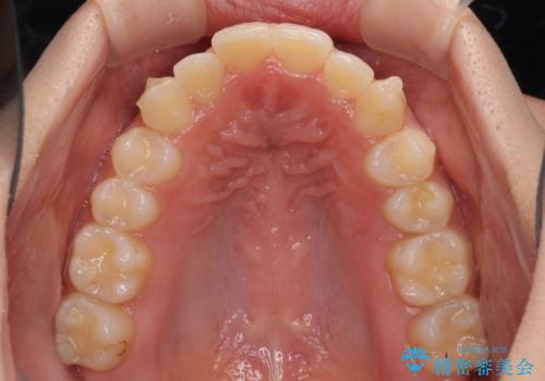 骨格的に左右にずれいている 前歯のデコボコをインビザラインで解消の治療中