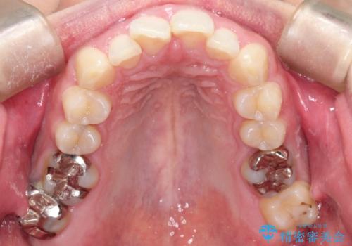 前歯が前後反対にかんでいる インビザラインによる矯正の治療中