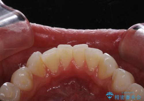 ホワイトニング前にPMTCの治療前