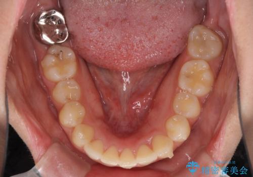 骨格的に左右にずれいている 前歯のデコボコをインビザラインで解消の治療中