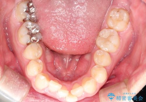 全体のガタガタをインビザラインできれいな歯並びへの治療前