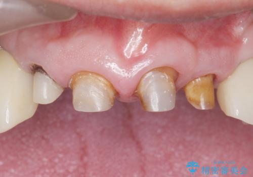 被せ物がとれたまま放置していた セラミックで綺麗に 50代男性の治療中