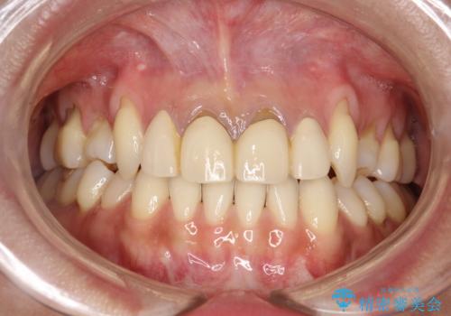 前歯のかぶせ物をオールセラミックへ 形を含めて理想の前歯への症例 治療前