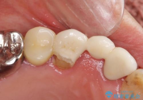 被せ物がかけた 綺麗で丈夫なセラミックのブリッジへ 60代女性の治療中