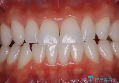 ホワイトニング前にPMTCの治療後
